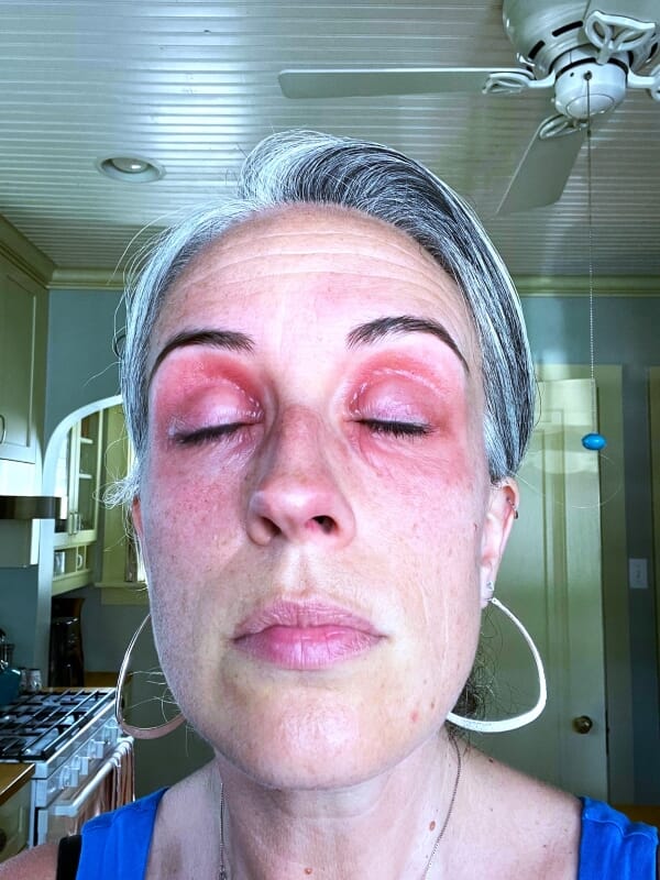 Best eye cream for eye eczema clears mum's agonising perimenopausal eye eczema in days