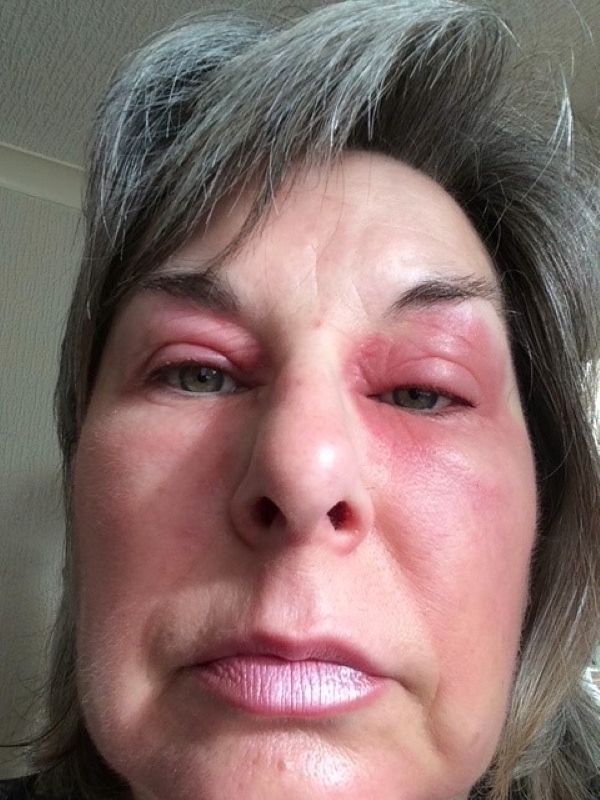 Beer triggers woman’s menopausal blepharitis but a vine eye gel ended suffering when nothing else worked