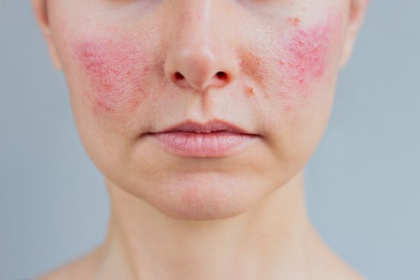New study finds antidepressants effective for treating rosacea