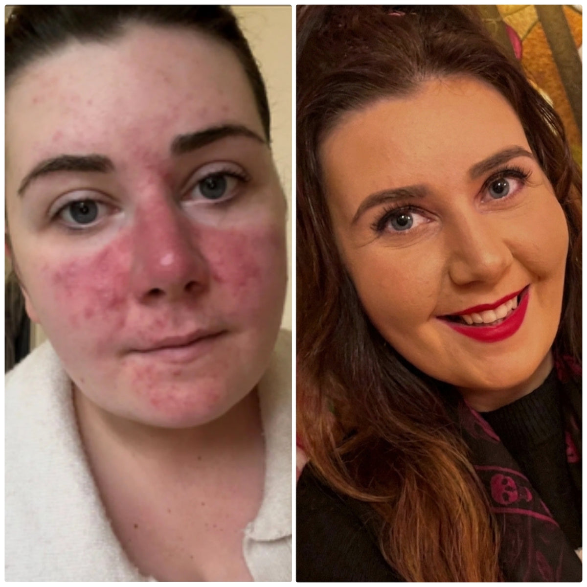 Before and after photos of a KALME customer with rosacea, showing pronounced facial redness and bumps across the cheeks before, and an even, confident complexion wearing KALME Chameleon Concealer after using the Kalme Advanced Skincare Kit daily