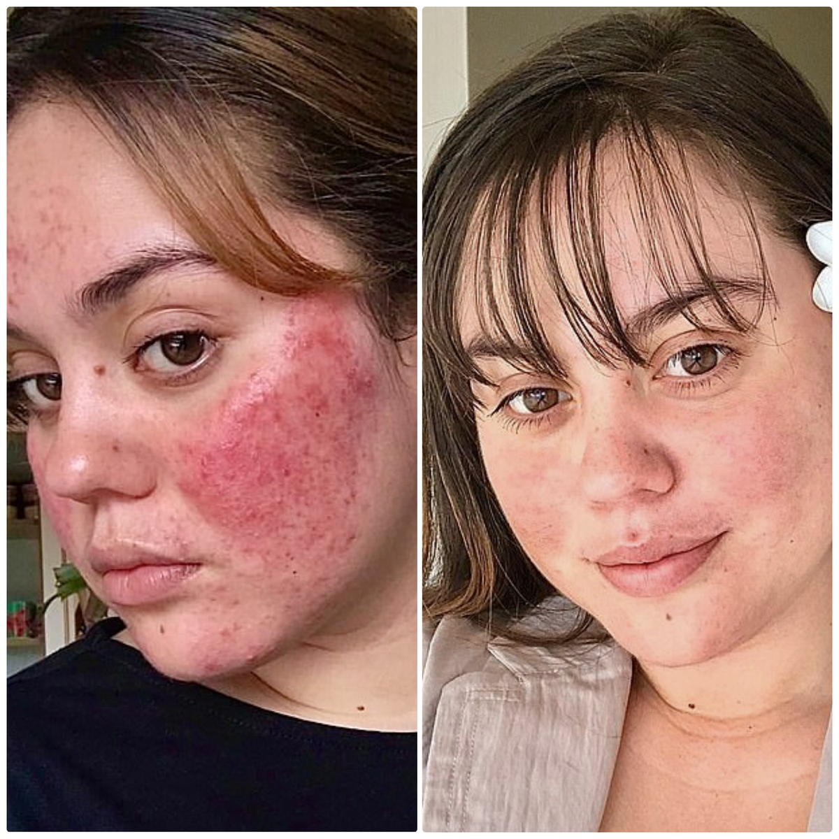 Before and after photos of a KALME customer with rosacea, showing pronounced facial redness and bumps across the cheeks before, and visibly calmer, more even skin after using the Kalme Essential Skincare Kit daily