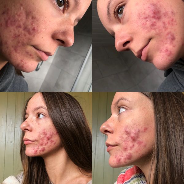 Woman in therapy due to her acne clears skin with mustard cream
