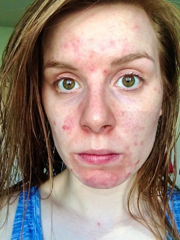 Silver serum clears teaching assistant's agonising adult acne just before she resorted to medication
