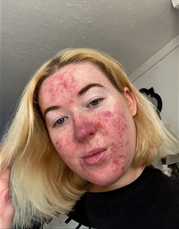 Young woman who developed rosacea as a teenager finds magical concealer that cleared her skin