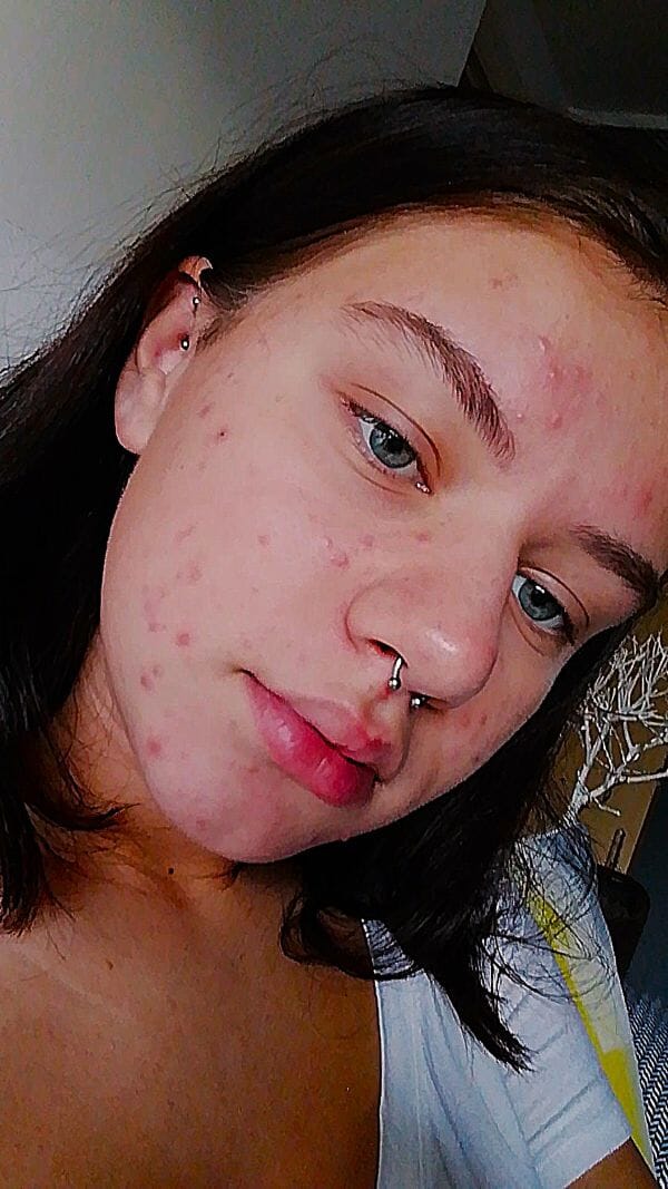 Young woman emotionally scarred from acne bullying finds a silver cream that clears her skin