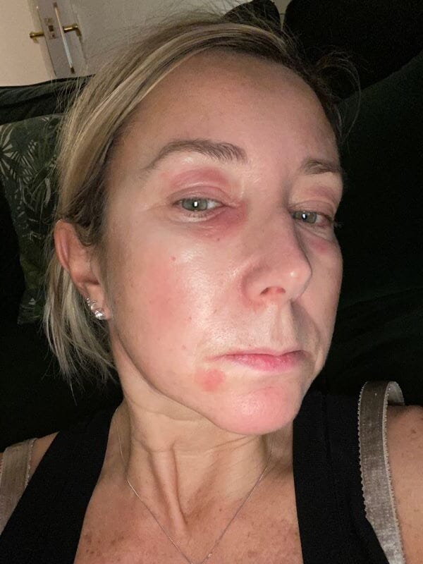 Mum with perimenopausal eye eczema hid at home until best cream for eye eczema helped her return to fashion career