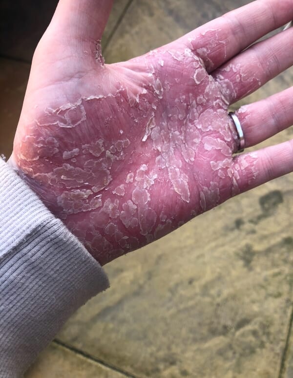 New mum who couldn't change her baby's nappy due to her painful hands finds best solution for hand psoriasis without steroids