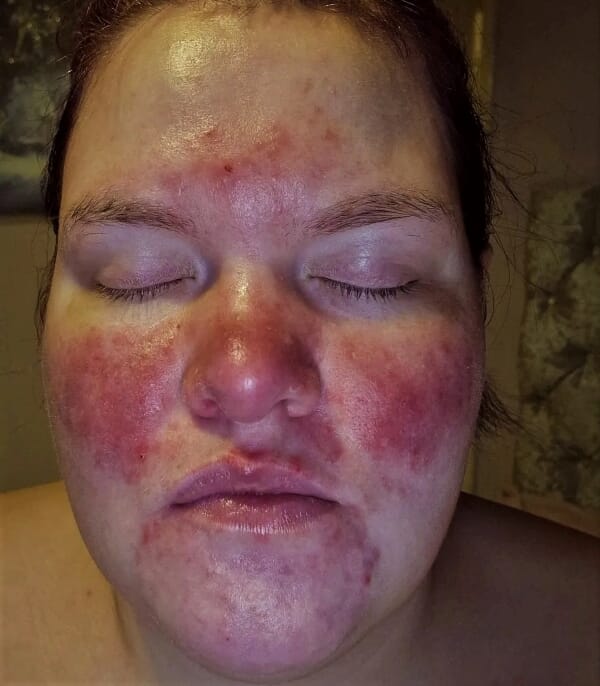Cold weather made rosacea sufferer's face bleed