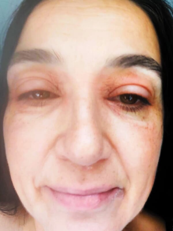 Women with ‘toad eyes’ from menopausal eye eczema discovered best eye cream that cleared it in days