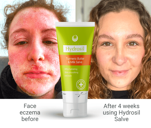 Young mum with TSWS finds best natural cream for eczema containing plant-steroid and donkey milk clears skin in weeks