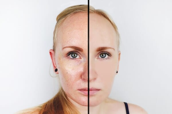 5 hacks for handling oily summer skin