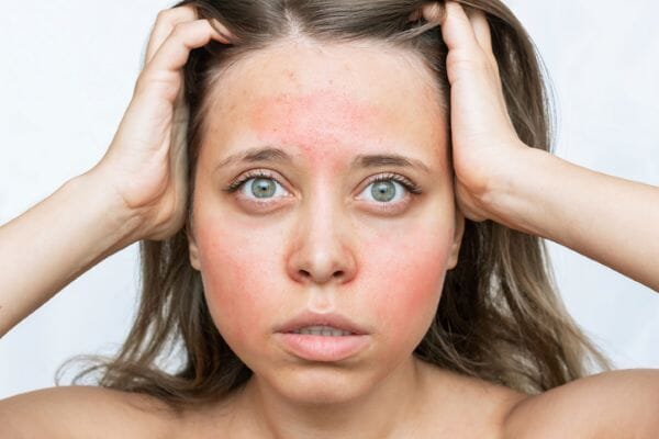 Could your acne actually be rosacea?