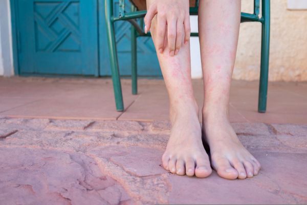 6 Spring Scares for Psoriasis Prone Skin