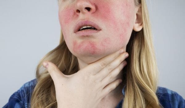 6 skin doctor tips to quickly recover skin from retinol burn