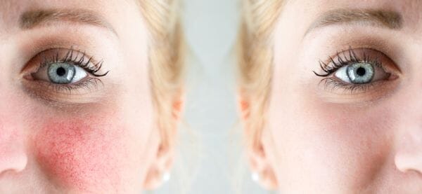 7 health conditions which can cause rosacea