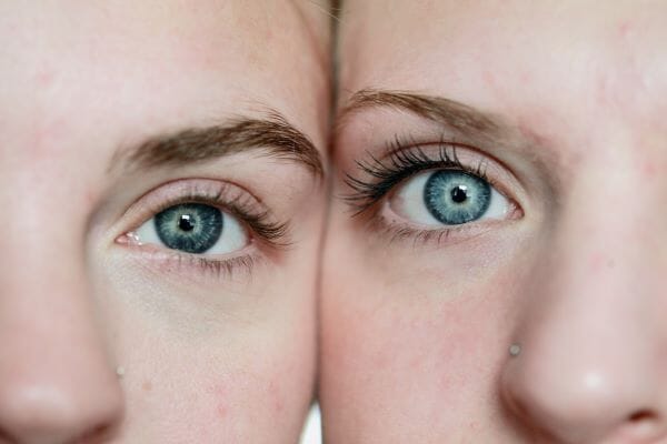 5 tips to make acne prone skin look better without using concealers or foundations  