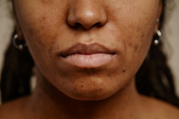5 Tips to Control Oily Skin