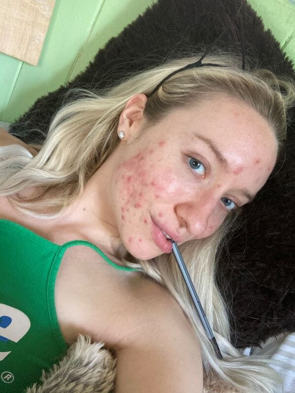 Abusive relationship triggered marketing consultant's cystic acne