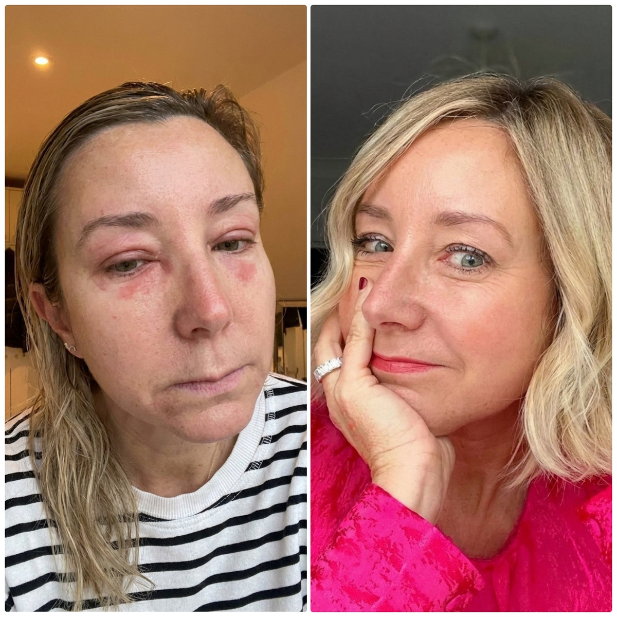 Before and after of a woman who used Hydrosil Dry Eye Care Duo Pack