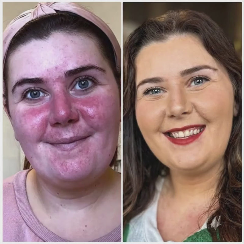 Before and after photos of a real customer with rosacea-prone skin, showing visibly reduced facial redness and calmer, more even-toned skin after using KALME Night Repair Cream