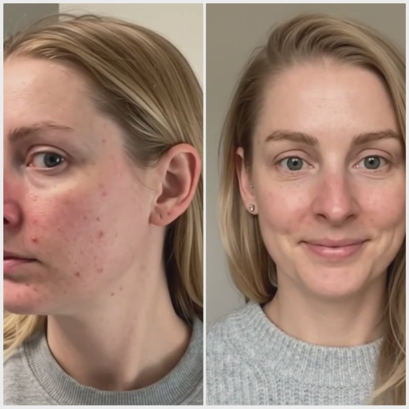 Before and after video of a woman with rosacea-prone skin. Before: visible redness and bumps across her cheeks and nose. After: calmer, clearer, more even skin following consistent daily use of the KALME routine, applied over KALME Undercoat desensitising moisturiser.